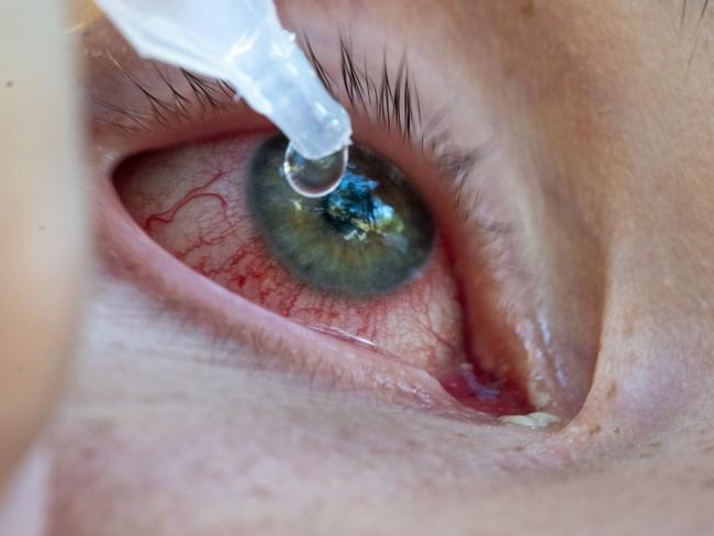 Conjunctivitis is increasing in children with the new Covid variant.