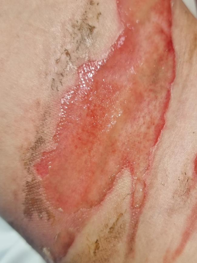 One of the scald burns on Dakota’s leg.