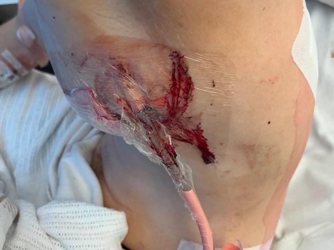 Paramedics believe the young man would have been paralysed if the stab wounds were any closer to his spine. Picture: Supplied