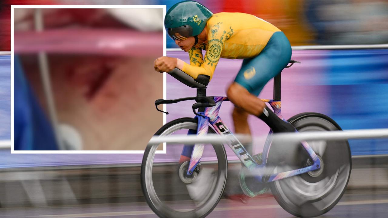 Video: Olympic cyclist reveals gruesome injury