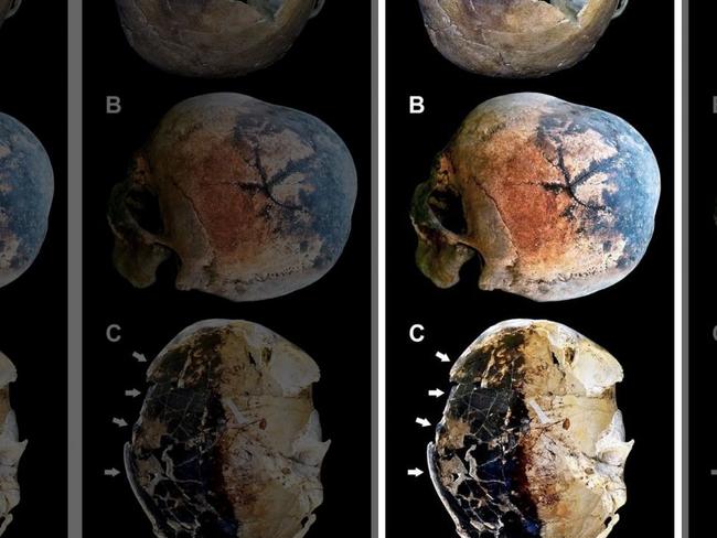 (A) The skull of an older-aged adult male showing a dark stained and cracked parietal bone. (B) Skullcap affected by a “stellate” fracture from explosion inside. (C) Exploded skull showing a partly dark stained inner table. The skull of this victim was lying in the ash bed on its left side. Picture: PLoS One