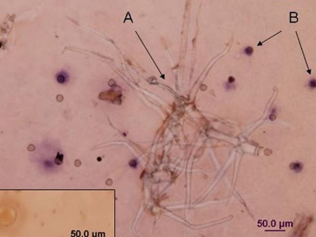 The barbed wire type trichomes under the microscope. Picture: Professor Connie Katelaris