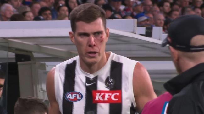 Cox shows off the injuries. Credit: Fox Footy.