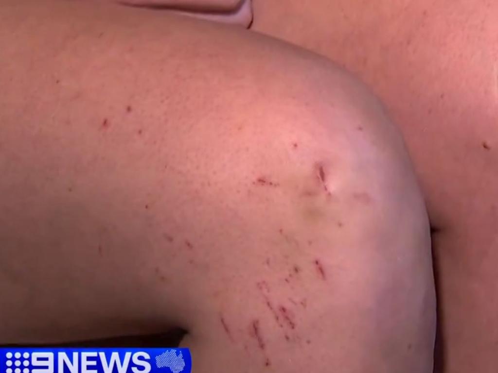 Some of the scars on the legs of the woman involved in a terrifying attack at Mt Coot-tha last week. Picture: 9 News Queensland