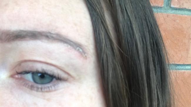 Katharine’s brows today — with a little scarring remaining.