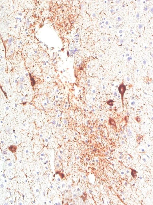 Paul Green’s scan stained for the protein tau showing a high level of CTE