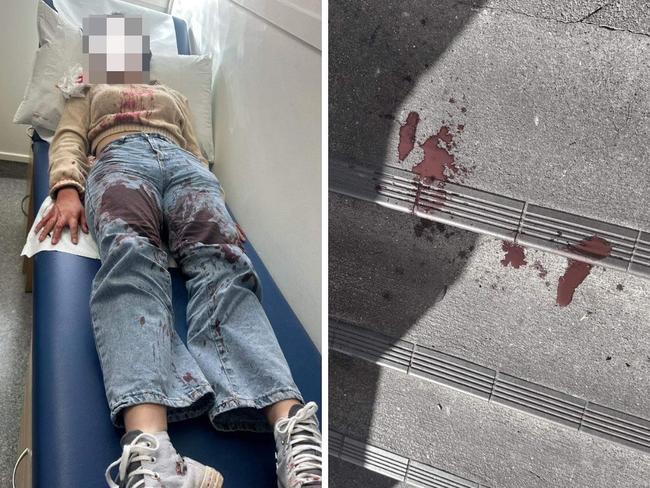 A distraught mother has shared confronting photos of her 12-year-old covered in blood after being beaten outside a McDonald's in New Zealand. Picture: Supplied