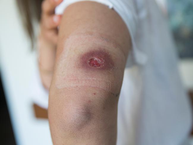 Bianca Ludowyke and 1-year-old baby Isla, who were infected with Buruli Ulcers.The Mornington Peninsula continues to be affected by the spread of the mysterious Buruli Ulcer, with infected patients continuing to be reported with greater numbers than the year before.Photo by Paul JeffersThe Australian11 Oct 2018