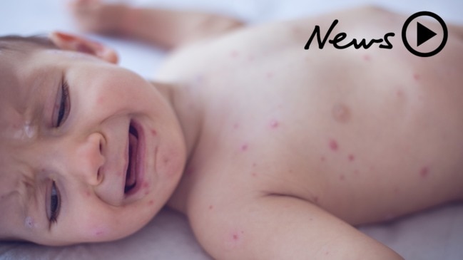 Measles outbreak: If you're born in these years, you could be at risk