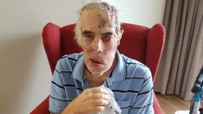 Cancer patient John Callaghan was left with open and undressed wounds and ended up with maggots in his ear. Picture: Supplied