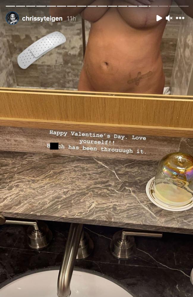 Chrissy Teigen Poses Topless on Instagram After Having Her Breast