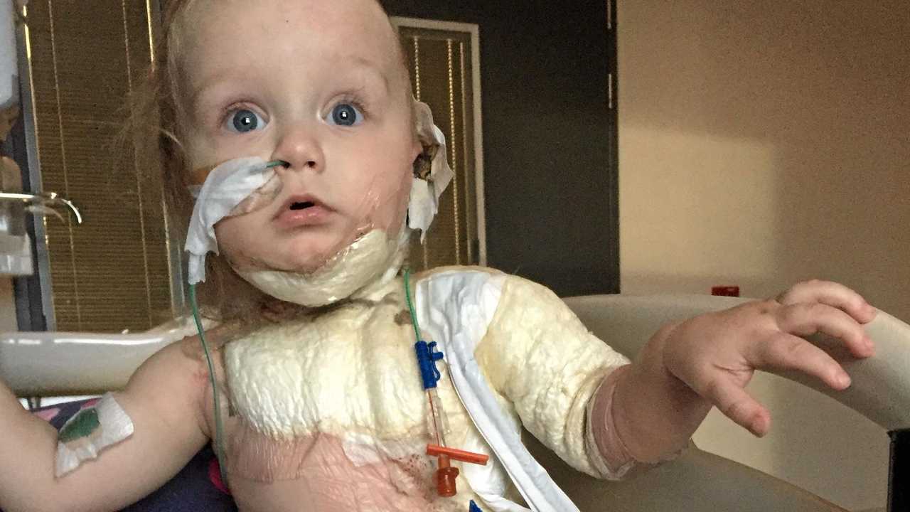 How You Can Help Bring Little Burns Victim Home | The Courier Mail