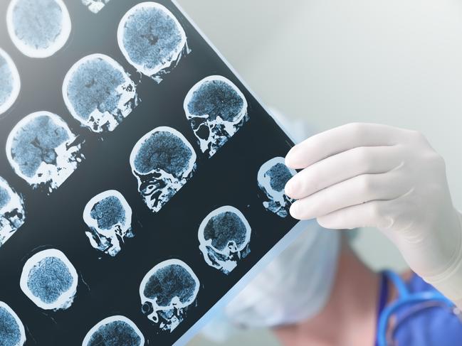British scientists have developed a first-of-its-kind test that can anticipate dementia in a person up to nine years before a diagnosis. Picture: Supplied