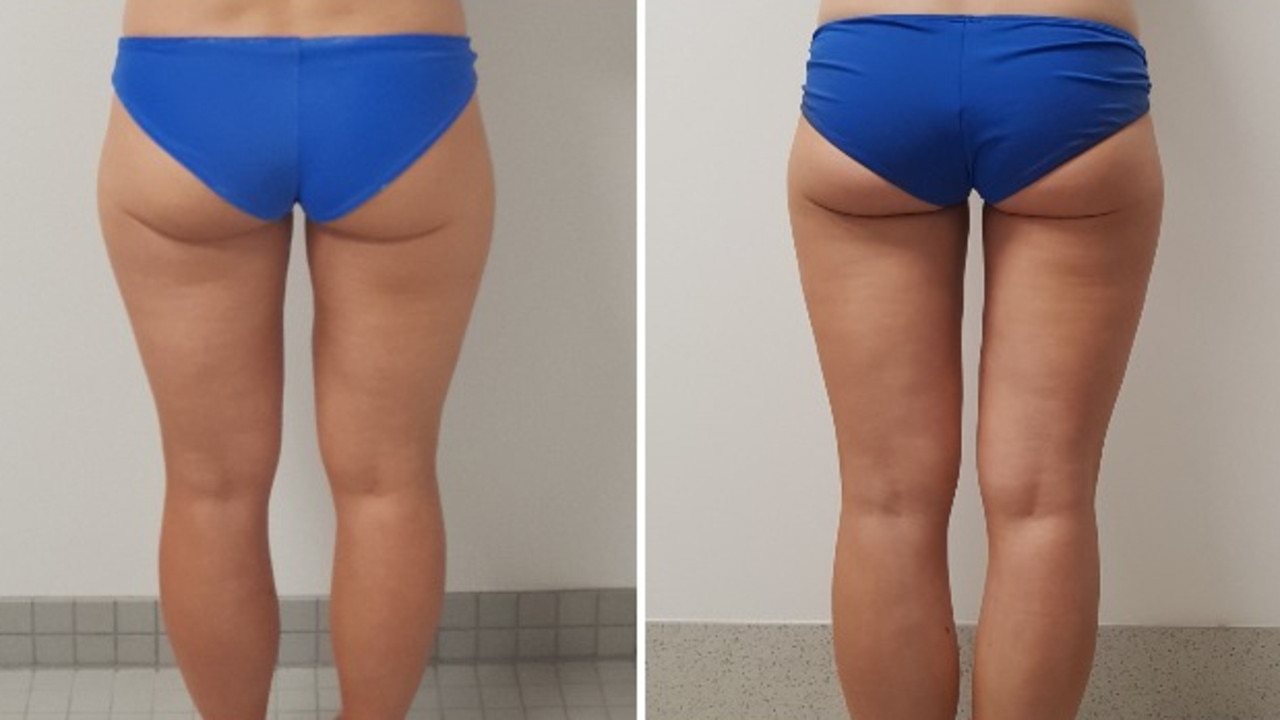 Coolsculpting Before And After Legs