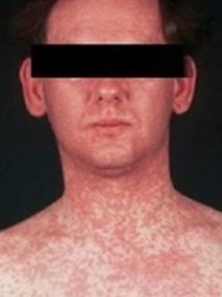 A typical measles rash. Picture: File