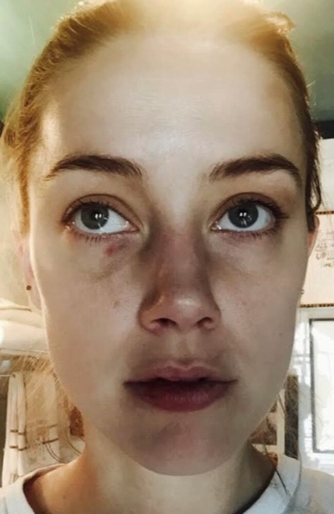 Photos of Johnny Depp’s ex-wife Amber Heard’s injuries were shown in court. Picture: Court Photo