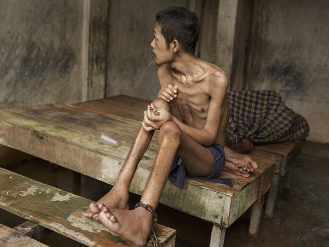 Before he died, this man lived chained to a platform at Kyai Syamsul’s traditional healing centre in Brebes, Central Java. While there his ankles swelled and his body became emaciated. Picture: Andrea Star Reese/Human Rights Watch.
