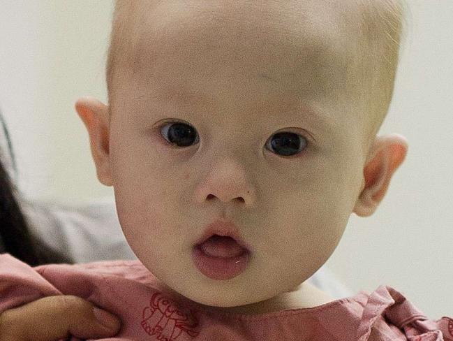 Baby Gammy was born with Down syndrome, at the Samitivej hospital. AFP PHOTO / Nicolas ASFOURI