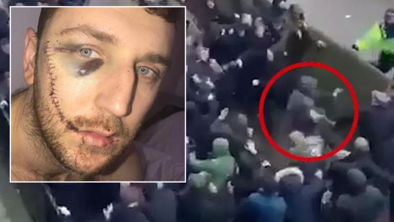 Everton fan Jay Burns was slashed in the face during a fight with Millwall supporters.