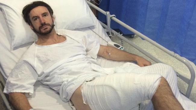 Gareth Clear underwent a skin graft after being burnt by the exploding iPhone.