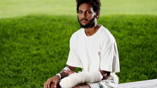 Crocodile attack survivor Isaac Adidi in Cairns after surgery on his hand from being mauled by a 3m croc at a swimming hole near Weipa in February this year. Picture: Stewart McLean