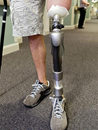Bionic leg ... One of A/Prof Al Muderis’ first patients models his robotic limb.