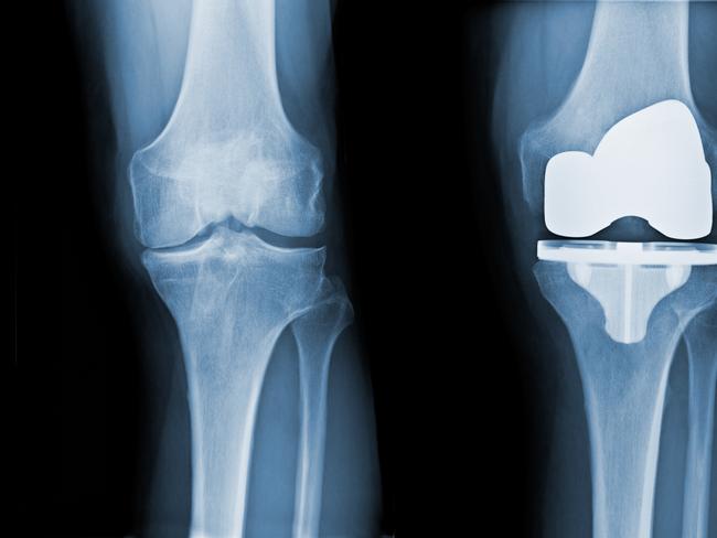 Total Knee Replacement X-ray - before and after. Picture: istock