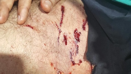 The wounds on one of the victims during the dog attack at Lakemba in January.