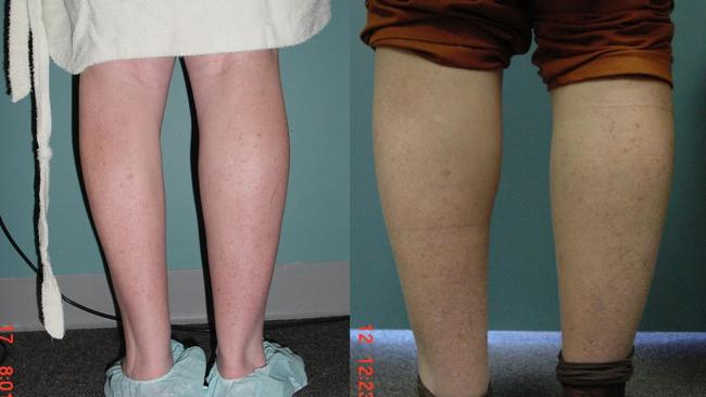 Before and after in a calf enhancement procedure. 