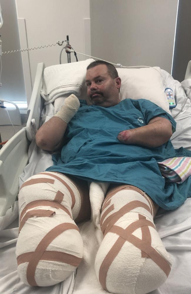 Jason 'Buddy' Miller after his second operation his feet were amputated. Mr Miller, has also had his hands amputated after he suffered severe sepsis and nearly died. Picture: Supplied.