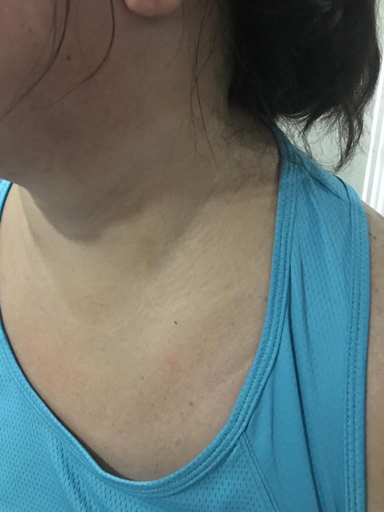 Chantel says she was strangled during the attack, leaving her with bruises around her neck. Picture: Supplied