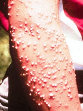 Pustules resulting from fire ant stings. Picture: University of Georgia