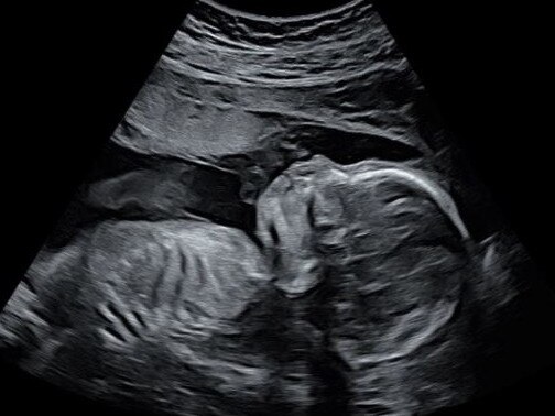 Jess Braude's baby scan at 20 weeks. The baby was screened for the BRCA gene.