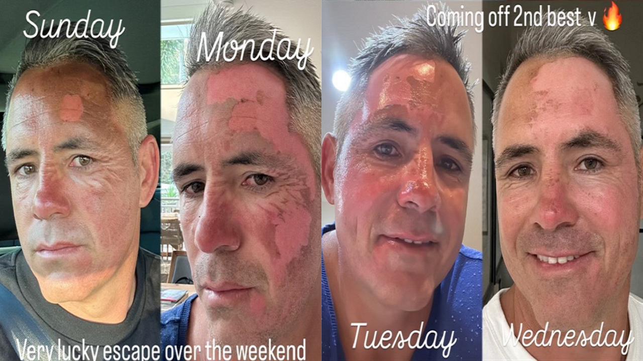 Sport Confidential: Corey Parker reveals brutal burn injuries