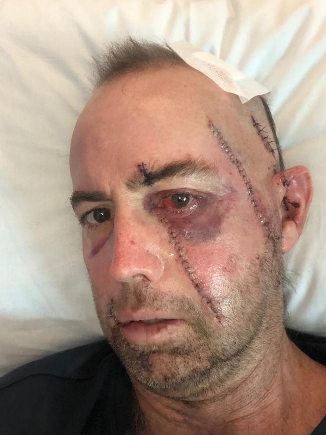 Gold Coast father Andrew was holidaying at Seaforth when he fell overboard and a boat propeller struck him in the face.