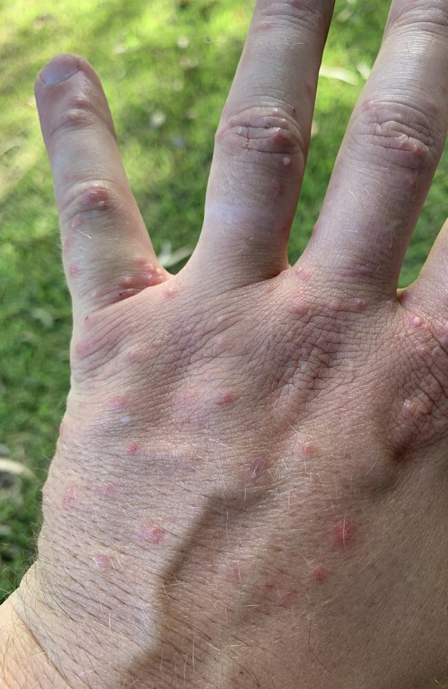 Invasive Species Council Advocacy Director Jack Gough's hand a week after he was stung by fire ants. Picture: supplied