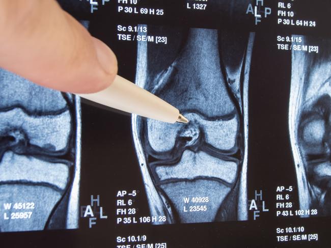 Knee joint x-ray or MRI. Doctor pointed on area of knee joint, where pathology or problem is detected, such fracture, destruction of joint, osteoarthritis. Diagnosis of knee diseases by radiology.  Picture: istock