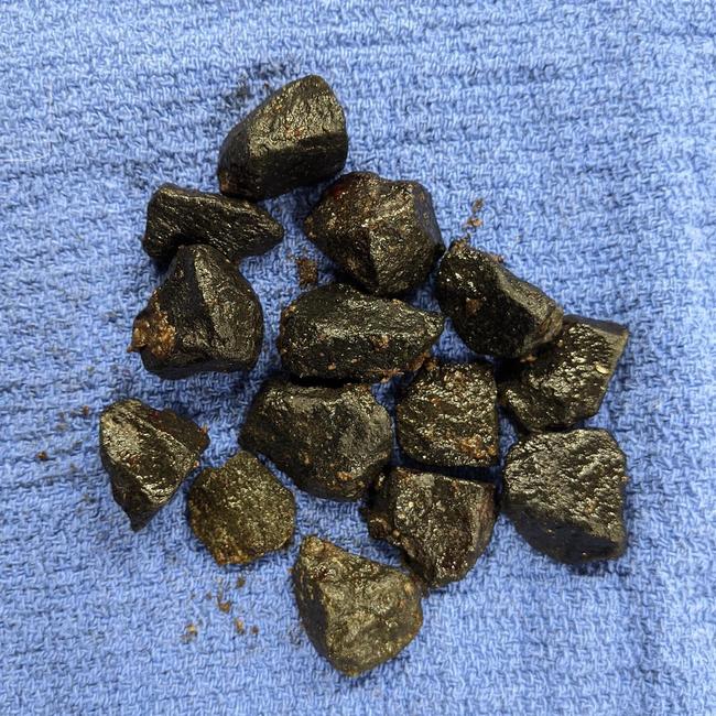 Rocks recovered by AHVEC staff from the stomach of a curious Pug. Source: SUPPLIED.