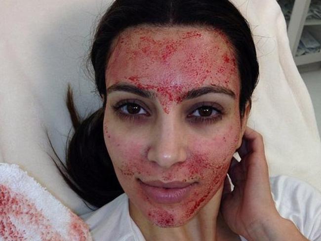 Kim Kardashian famously posted this picture of herself getting a vampire facial in 2015.