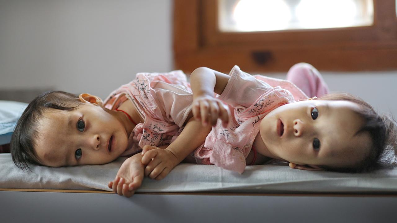 Lifetime bond in separation: surgery for twins Nima and Dawa | The  Australian