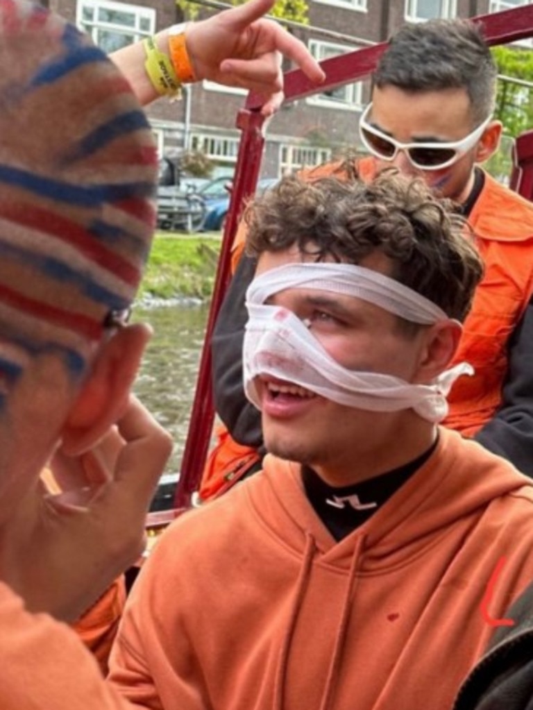 Lando Norris had a busted up nose in Amsterdam. Photo: Twitter.