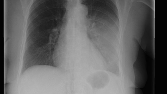 Meliocxr - Pneumonia - xray of affected lungs - grey area marks diseased tissue