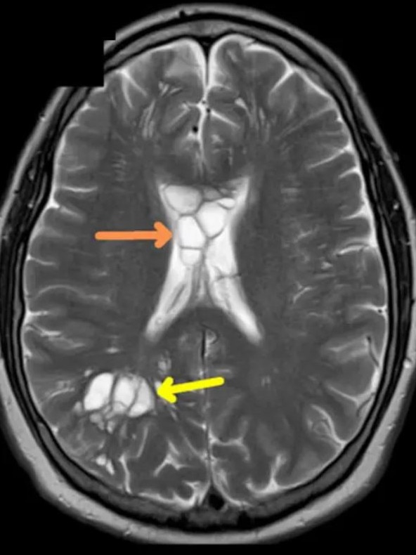 The man was found to have developed swelling and cysts in his brain. Picture: American Journal of Case Reports