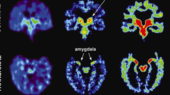 The left image shows a normal brain scan and the middle and right images show scans of NFL players with progression of CTE. Picture: UCLA