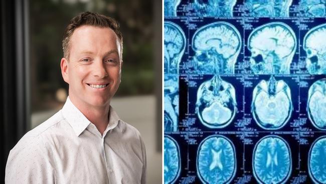 Monash University researcher Chris Moran’s study shows brain health is improved by exercise.