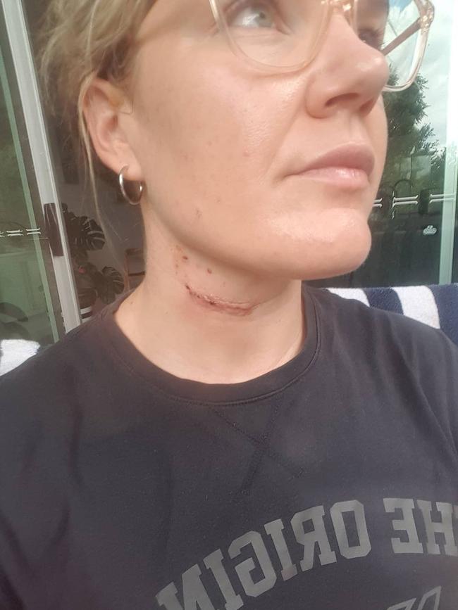 The scar that was left behind. Picture: Instagram
