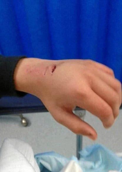 Jeremy Harvey has puncture wounds in his left hand from a dog attack. Picture: Contirbuted