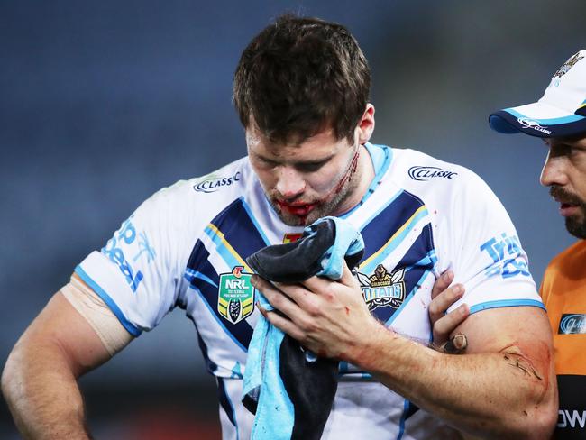 Titans trainers had to stitch up Anthony Don’s mouth.