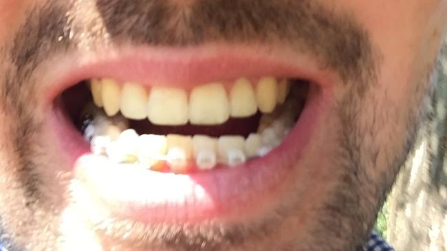 Jack’s bottom braces.