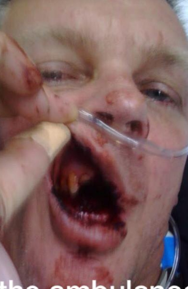 Ricky Wood shows off his injuries. Picture: Facebook.